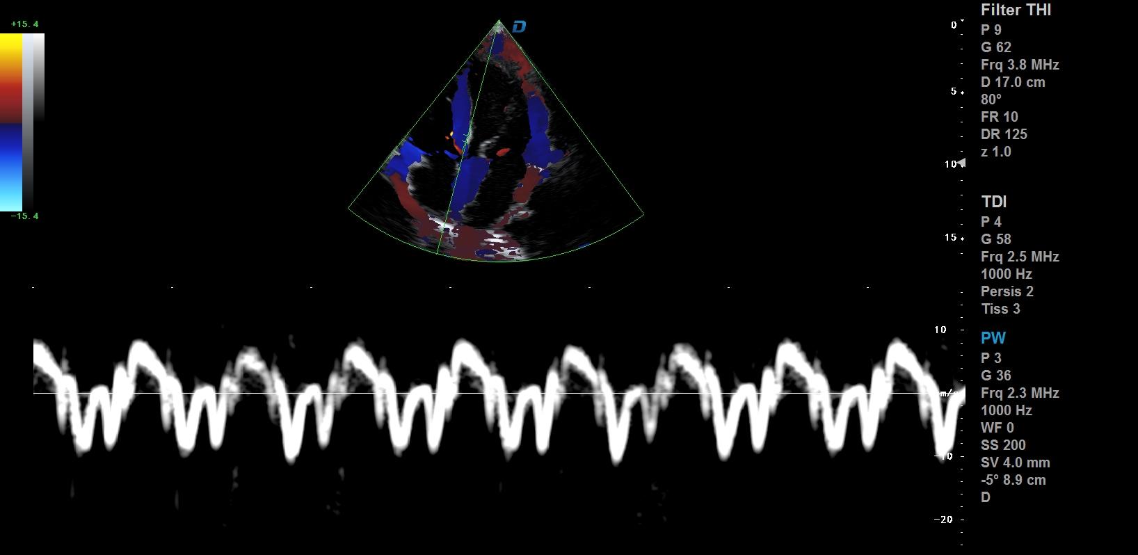 心臟彩超機(jī)和超聲心動圖的區(qū)別？